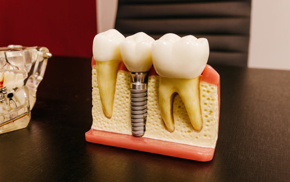 3 Reasons Dentists Recommend Dental Implants vs Dentures