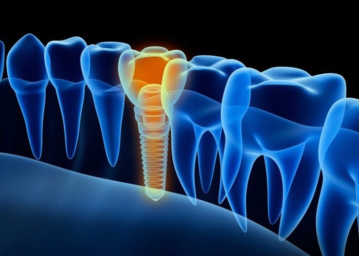 Halitosis – Causes, Symptoms, Treatments