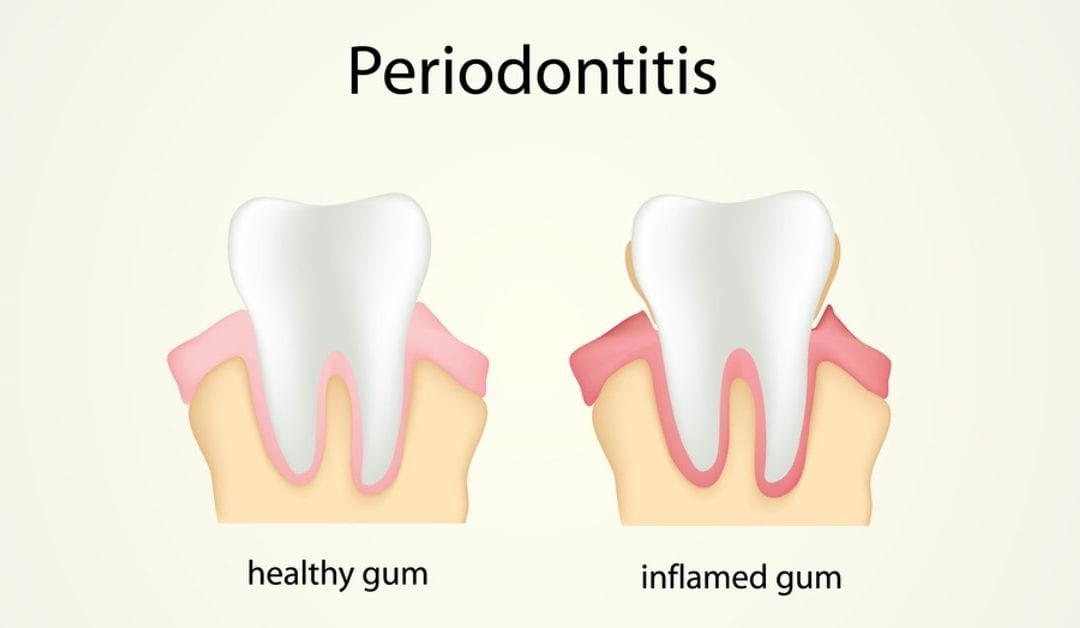 Mouth Ulcers – Treatment and Prevention